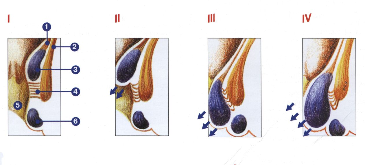етапи на развитие на хемороиди