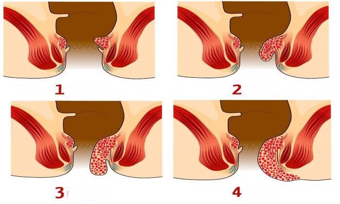 как изглеждат хемороидите на различни етапи